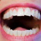 Risicofactoren tandvleesontsteking