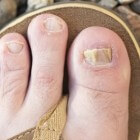 Dikke nagels of verdikte nagels: symptomen en behandelen