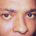 Gele ogen en gele huid: oorzaken, symptomen en behandeling