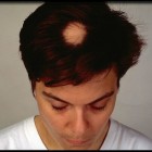 Alopecia areata: symptomen, oorzaak, behandeling en prognose