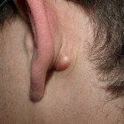 Bult achter oor, in hals of knobbeltje in nek, lies of oksel
