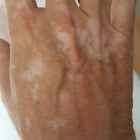 Vitiligo: als de kleur geleidelijk verdwijnt uit de huid