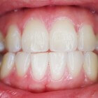 Bultje op tandvlees: symptomen & oorzaken bult op tandvlees