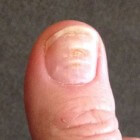 Lijnen van Beau: overdwarse groeven nagel / deuken nagel