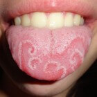 Aandoeningen aan de tong & Oorzaak en behandeling | Mens en Gezondheid