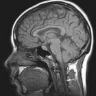 Pseudotumor cerebri: een verhoogde druk in het hoofd