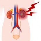 Nierpijn: oorzaken pijn aan de nieren, nierstreek en rugpijn