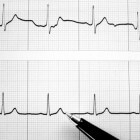 Hartritmestoornissen  onregelmatige hartslag