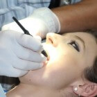 Gaatjes of tandbederf in tanden: symptomen en behandeling