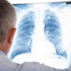 Longfibrose: symptomen, oorzaken, behandeling en prognose