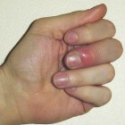 Ontstoken vinger: symptomen, oorzaak en behandeling fijt