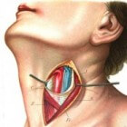Vernauwing van de halsslagader (arteria carotis stenose)