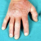Dermatitis herpetiformis (ziekte van Dühring): symptomen