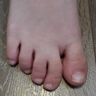 Syndactylie: met elkaar vergroeide tenen of vingers