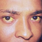 Gele oogkleur: Oorzaken van geelverkleuring van de ogen