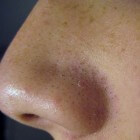 Mee-eters verwijderen op neus en gezicht: tips behandeling