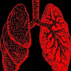 Pulmonale arteriële hypertensie: Aandoening aan de longen