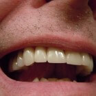 Tandabces: Ophoping van pus in tand door bacteriële infectie