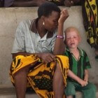 Albinisme: Afwijkingen aan ogen, huid en haar