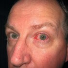 Oogafscheiding door ooginfecties, contactlenzen of oogletsel