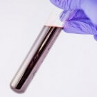 Bloedonderzoek: Alfafoetoproteïne (AFP) test