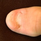 Nail patella syndroom: Afwijkingen aan nagels & knieschijven