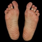 Ziekte van Ledderhose: Soms pijnlijke knobbeltjes onder voet