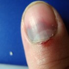 Bloeding onder de nagel: Subunguaal hematoom