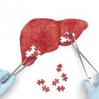 Uitzaaiingen in de lever: behandeling van levermetastasen