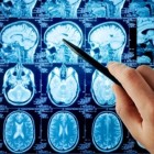 Uitzaaiingen in de hersenen: symptomen hersenmetastasen