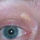 Xanthelasma: Gele cholesterolafzettingen rond de ogen