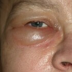 Gezwollen ogen & oogleden: Oorzaken, symptomen & behandeling