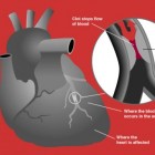 Afgestorven hartcellen vernieuwen niet na een hartinfarct
