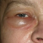 Gezwollen ogen of oogleden: oorzaken zwelling rond de ogen