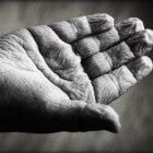 Huiduitslag aan handpalm: Oorzaken, symptomen en behandeling