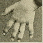 Dactylitis: Gezwollen vingers en/of tenen door aandoening