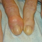 Gezwollen vingers: oorzaken en behandeling opgezette vingers