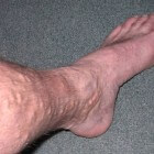 Spataders: Oorzaken en behandelingen van spataderen in benen