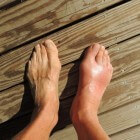 Teenpijn: Pijn aan teen of tenen door aandoening of letsel