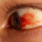 Rode vlek in oog: oorzaken en symptomen van bloed in het oog