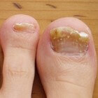Bruine nagels: oorzaken en symptomen van bruine vlekken