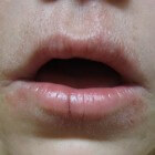 Periorale dermatitis: Huidziekte met huiduitslag rond mond