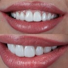 Trillende lippen: oorzaak van trillende onderlip of bovenlip