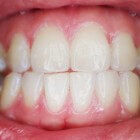 Donker tandvlees: Oorzaken van zwarte of bruine verkleuring