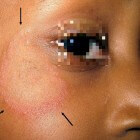 Tinea faciei: Schimmelinfectie met rode vlekken aan gezicht