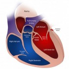 AVNTR: AV-nodale re-entry tachycardie (hartritmestoornis)