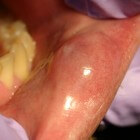 Slijmcyste (speekselkliercyste): Cyste in mond of op lippen