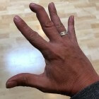 Hamervinger: Eindkootje van vinger niet meer kunnen strekken