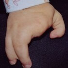 Ectrodactylie: Ontbrekende vingers met krabachtige handen