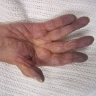 Blauwe handen en voeten: oorzaken van perifere cyanose